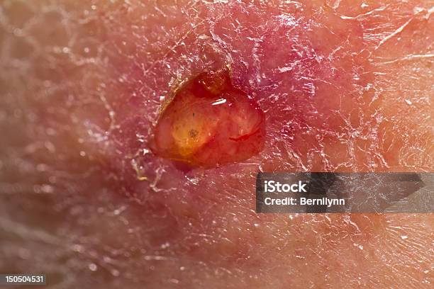 Ulceration Stock Photo - Download Image Now - Ulcer, Blood, Care