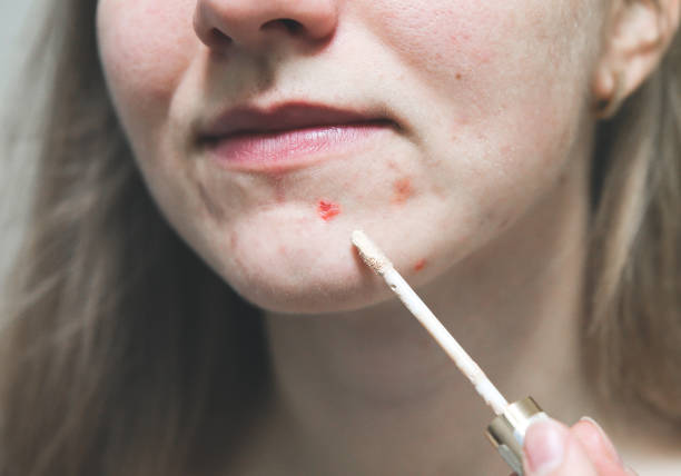 istock Woman is covering acne with concealer. Makeup for oily skin with problems. 1505105688