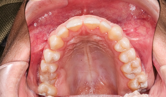 Dentistry case of upper maxillary arch, indirect occlusal view with buccal photography mirror.