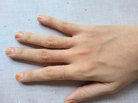 wearing a small ring causes marks on the fingers