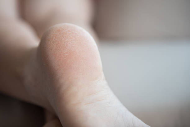 istock Rough, cracked skin on the heel. unkempt feet 1505901162