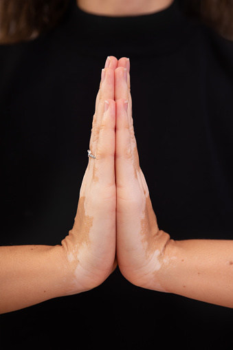 Woman with vitiligo making the lotus position while meditating