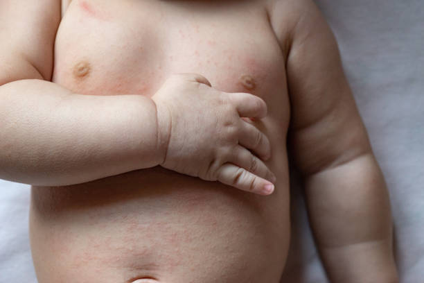 istock Red, Itchy Rash on Baby's Chest and Abdomen 1506992902