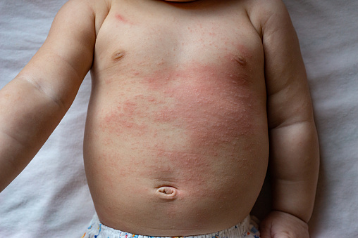 The baby is experiencing a red, itchy rash on their chest and abdomen. The rash appears as patches of inflamed, irritated skin that may be accompanied by intense itching. It is localized specifically on the baby's chest and abdomen, covering areas of the skin in these regions.