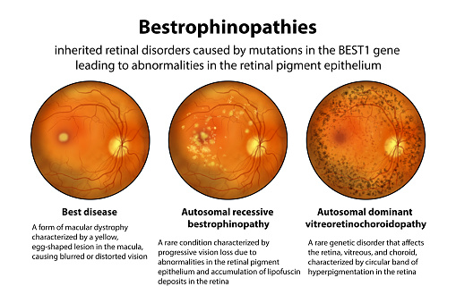 Bestrophinopathies, inherited retinal disorders caused by mutations in the BEST1 gene, illustration. Best disease, autosomal recessive bestrophinopathy and autosomal dominant vitreoretinochoroidopathy