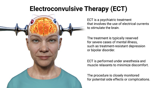 Electroconvulsive therapy, ECT, a treatment used for severe mental illnesses involving the use of electrical currents to stimulate the brain, 3D illustration