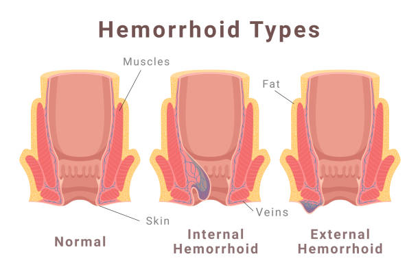 How to Prevent and Treat Recurring Hemorrhoids Effectively 2 recurring hemorrhoids and types of hemorrhoids illustration