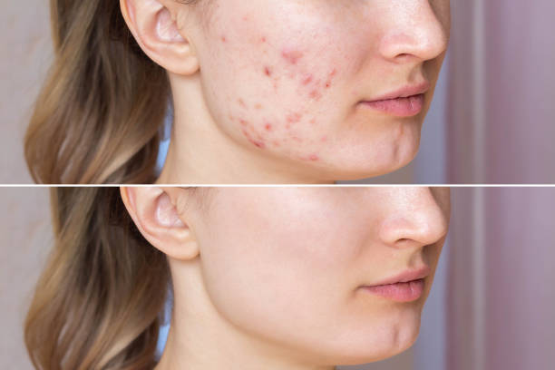 istock Young woman's face before and after acne  treatment on face. Pimples, red scars 1508860309