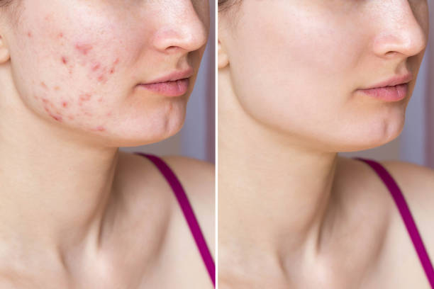 istock Cropped shot of young woman's face before and after acne treatment on face. 1508860310