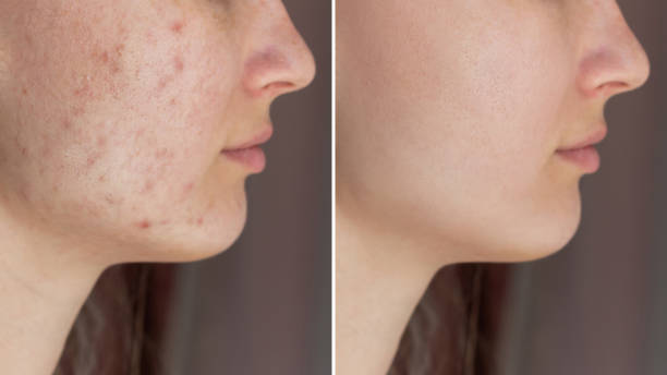 istock Young woman's face before and after acne treatment on face. Pimples, red scars, rash on cheeks and chin 1508881947