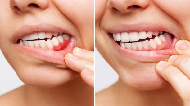 two shots of a young woman with red bleeding gums and health gums, before after treatment - gums imagens e fotografias de stock