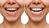 Cropped shot of a young caucasian smiling woman before and after veneers installation