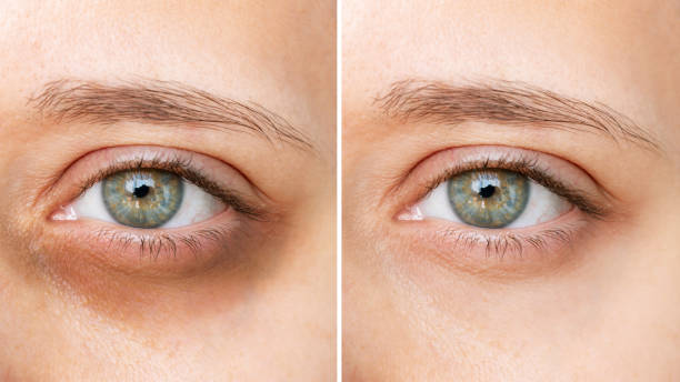 istock Young woman's face with dark circles under eyes before and after treatment. Result of using concealer 1509039664