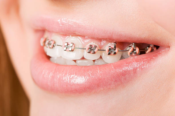 istock Young woman with brackets on teeth 150938154