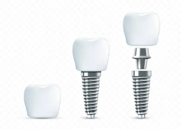 Vector illustration of Dental implant scheme. vector mockup