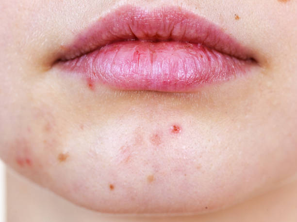 istock Female face with acne skin problem 1511919189