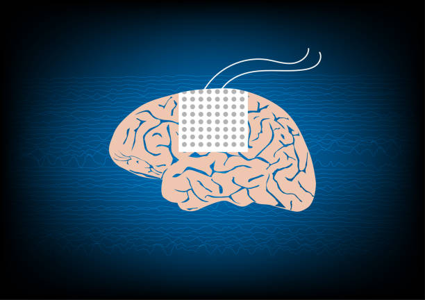 ilustrações de stock, clip art, desenhos animados e ícones de subdural electrode for brain waves monitoring in epilepsy surgery - eeg epilepsy science electrode