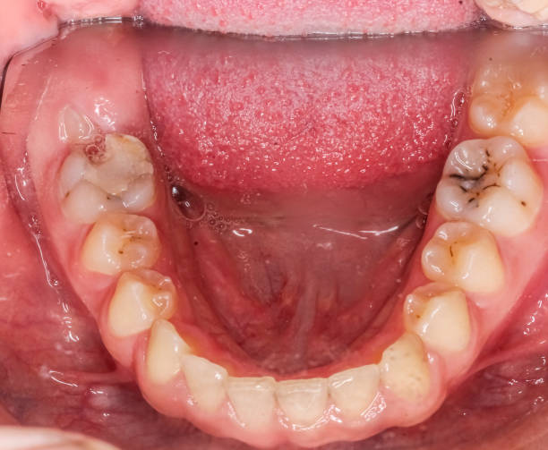 istock Lower mandibular arch indirect occlusal view with photography mirror. 1513899043