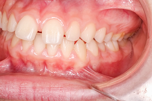 Oblique lateral view of dental maxillary and mandibular arches in occlusion with biting teeth, diastema gap between central incisors. Healthy gingival gum and no decay.