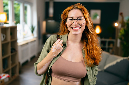 Portrait of confident redhead young Caucasian woman, with acne and vitiligo, in her home