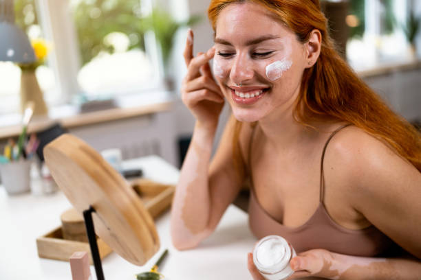 istock Woman with vitiligo and acne on her face, applying moisturiser 1514028309