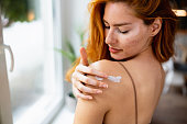Woman with vitiligo applying body cream on shoulder