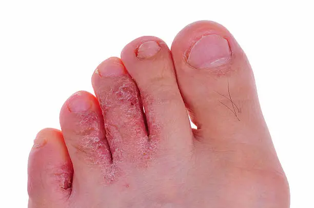detail view of the human foot that infected by athlete's foot fungus