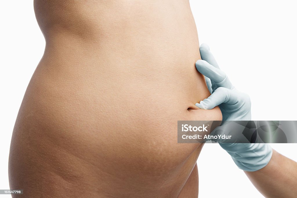 Weibliche Mitte Abschnitt schmaler vor Fettabsaugung - Lizenzfrei Arzt Stock-Foto