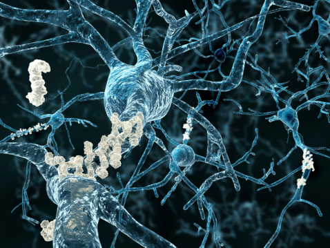 Amyloid plaques on axons of neurons affected by Alzheimer's disease