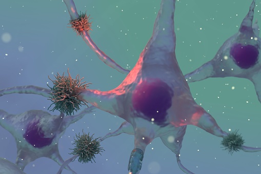 A protein responsible for Alzheimer's disease has recently been identified. It has been suggested that plaques of amyloid beta may inhibit transmission at neuronal synapses. This is a video showing a plaque-bound neuron. It is easy to see why neurotransmission is inhibited.