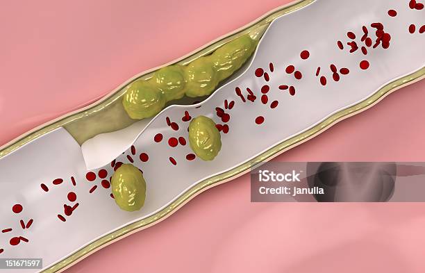 コレステロール流れる内静脈 - 血液のストックフォトや画像を多数ご用意 - 血液, アテローム性動脈硬化, コレステロール