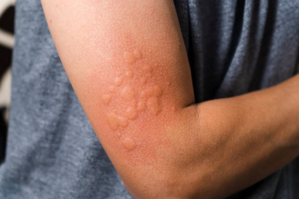istock Allergy injection on the skin. Man hand close-up, selective focus 1516948116