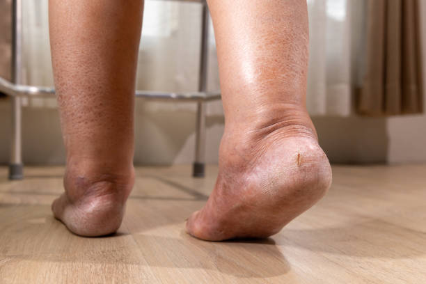 istock Woman's leg is edema (swelling) after cancer treatment. 1518321311