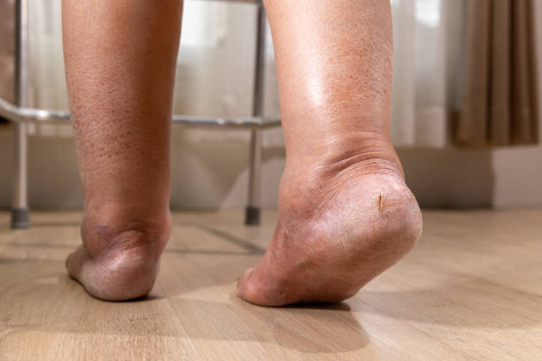 Woman's leg is edema (swelling) after cancer treatment. stock photo