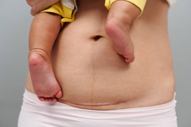 belly of woman with c-section scar of caesarean. mother holding her baby belly of woman with a c-section scar of caesarean. mother holding her baby scar stock pictures, royalty-free photos & images