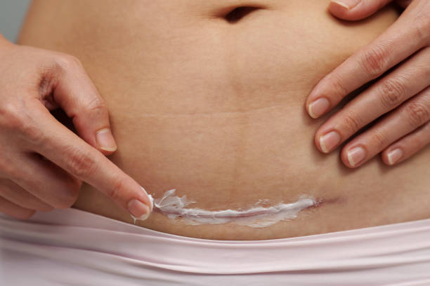 woman putting healing cream in c-section scar of caesarean woman putting healing cream in the c-section scar of caesarean scar stock pictures, royalty-free photos & images