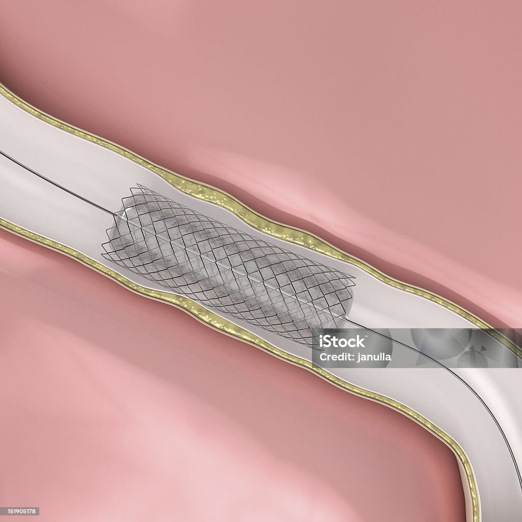 Angioplastie coronaire procédure balloon avec Endoprothèse vasculaire ouverture Artère lumen - Photo de Anatomie libre de droits