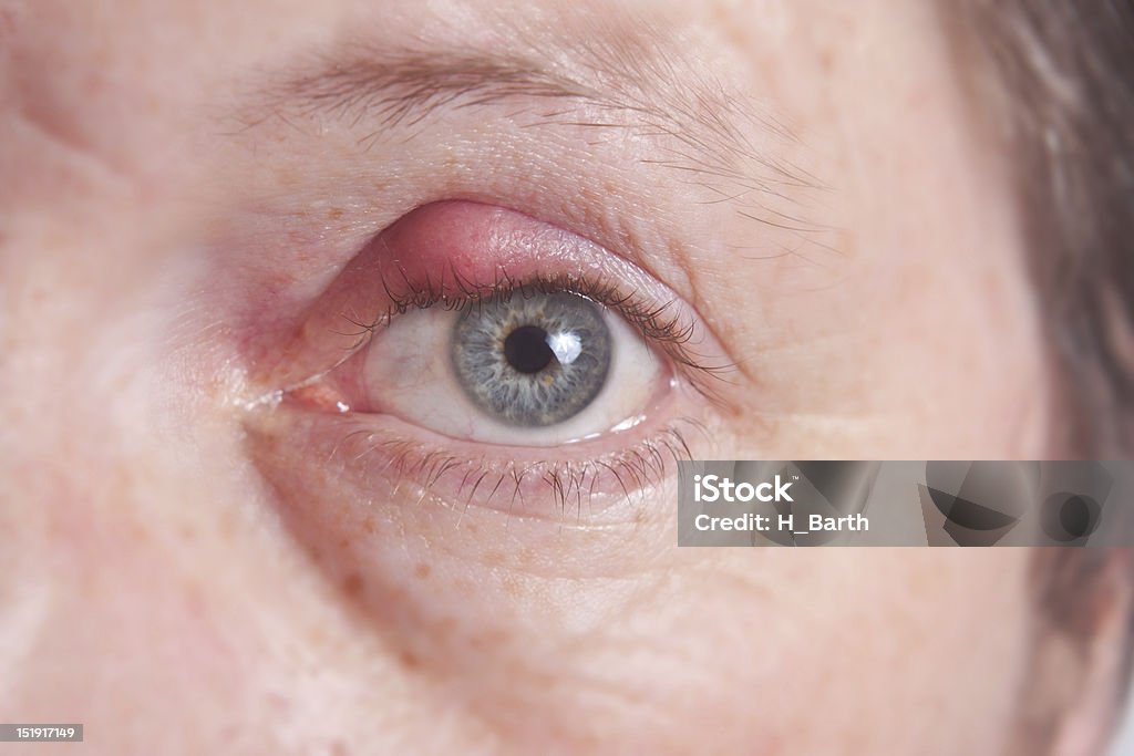 Close up of an eye with an infected eyelid Ckloseup of an inflamed eye with a sty. Stye - Infection Stock Photo