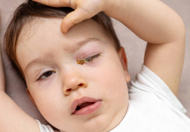 istock baby boy with conjunctivitis eye drops 1519395963