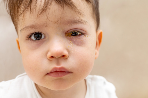 baby boy with conjunctivitis eye drops