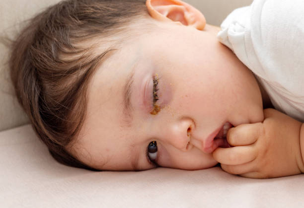 baby boy with conjunctivitis eye drops