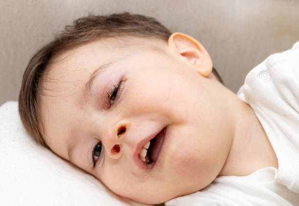 istock baby boy with conjunctivitis eye drops 1519395997