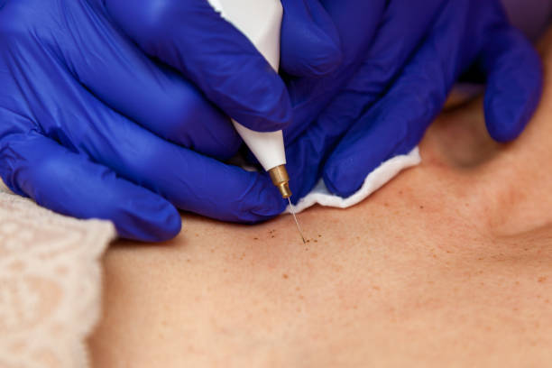 istock Removal of papillomas on the body 1519943667