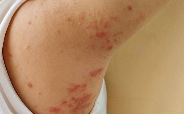 istock The chronic dermatitis, allergy and rash on the body. 1521178352