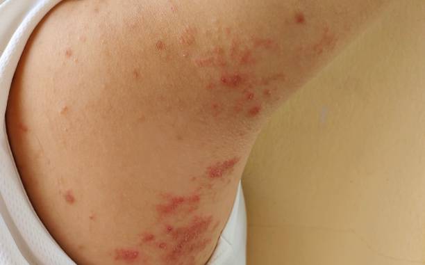 The chronic dermatitis, allergy and rash on the body. Portrait the chronic dermatitis, rash hives and itchy skin, problem pustules and allergy on the back of the woman, health care and medical concept. leprosy stock pictures, royalty-free photos & images