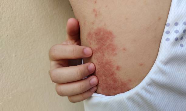 The chronic dermatitis, allergy and rash on the body. Portrait the chronic dermatitis, rash hives and itchy skin, problem pustules and allergy on the back of the woman, health care and medical concept. mycobacterium leprae stock pictures, royalty-free photos & images