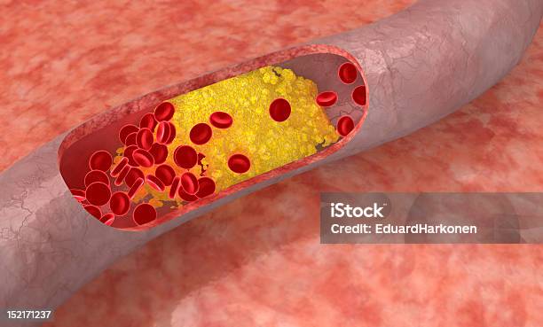 Colesterol En La Arteria Placa Foto de stock y más banco de imágenes de Arteria humana - Arteria humana, Asistencia sanitaria y medicina, Aterosclerosis