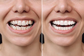 Нoung smiling woman before and after veneers installation. Сorrection of uneven teeth with