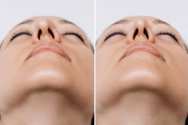 A close-up of woman's nose before and after rhinoplasty. Correction of the nasal septum A close-up of woman's nose before and after rhinoplasty on gray background. The result of cosmetic plastic surgery on the nose. Bottom view. Correction of the nasal septum. Beauty concept septum stock pictures, royalty-free photos & images