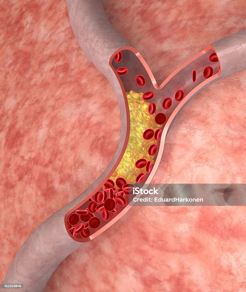 Colesterol en la arteria - Foto de stock de Colesterol libre de derechos